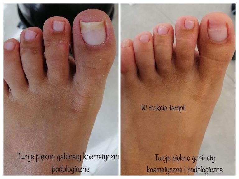 Onycholiza • Twoje Piękno